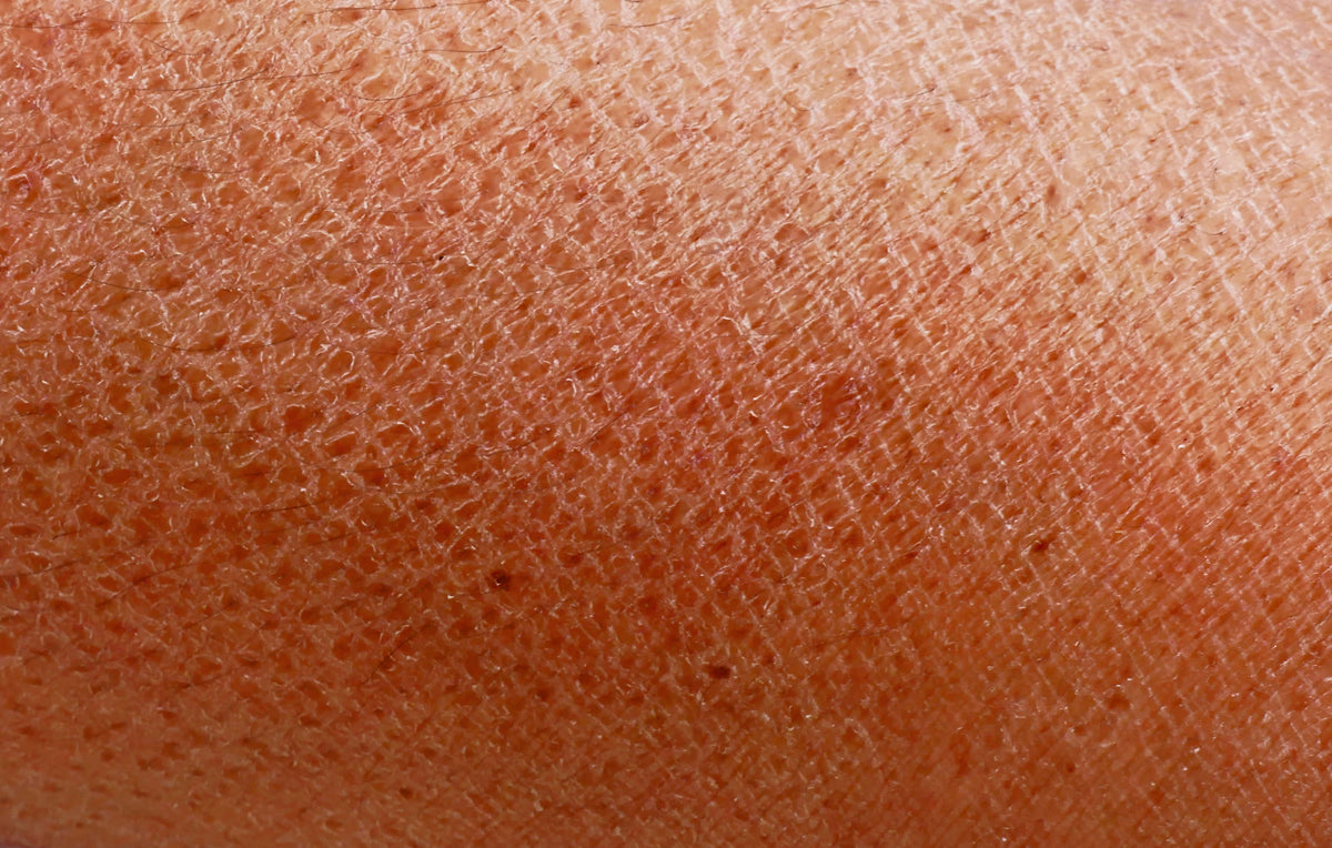 Detailaufnahme rissiger Haut